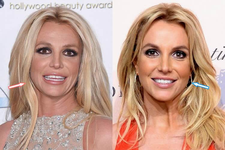 Did Britney Spears Have Facelift & Botox On Her Face?