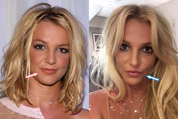 Did Britney Spears Get Lip Injections?