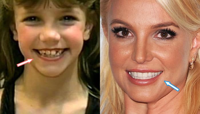 Britney Spears's Teeth