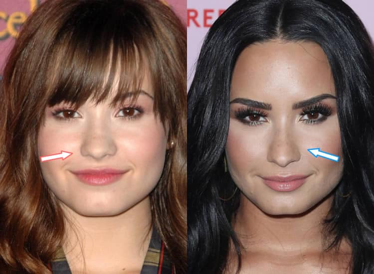 Did Demi Lovato Get A Nose Job?