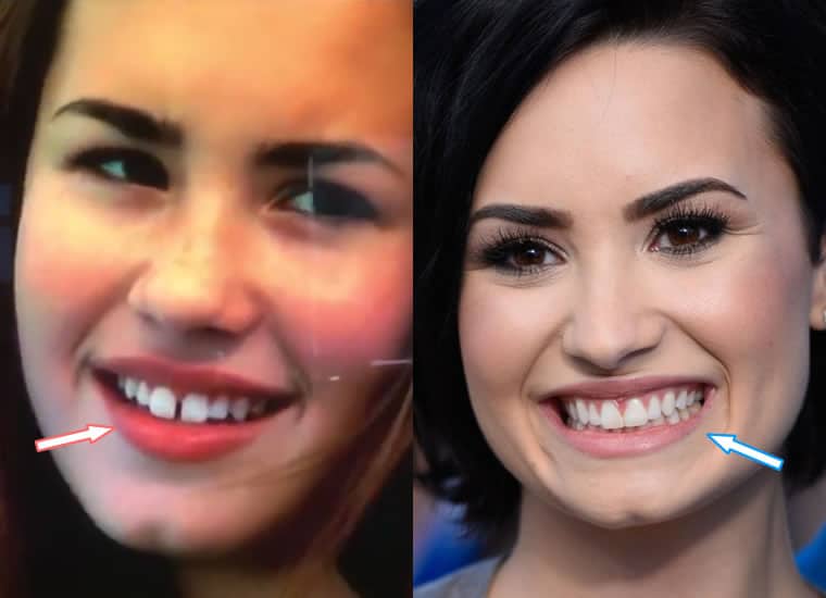 Has Demi Lovato Had Dental Work On Her Teeth?