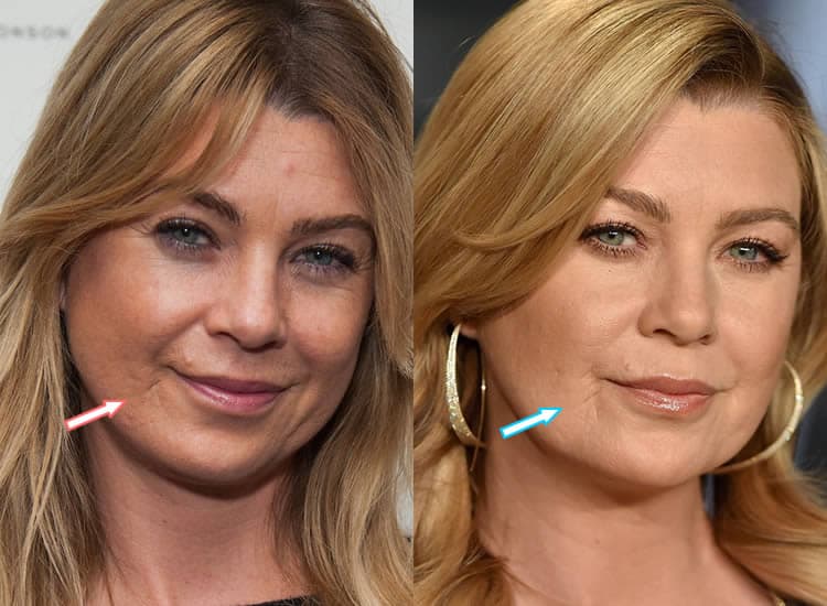 What happened to Ellen Pompeo's face and lip scar?
