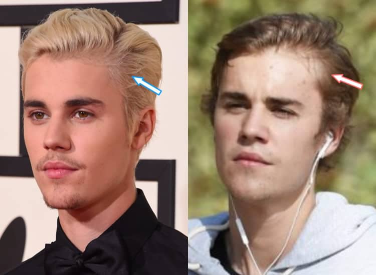 Is Justin Bieber Experiencing Hair Loss?