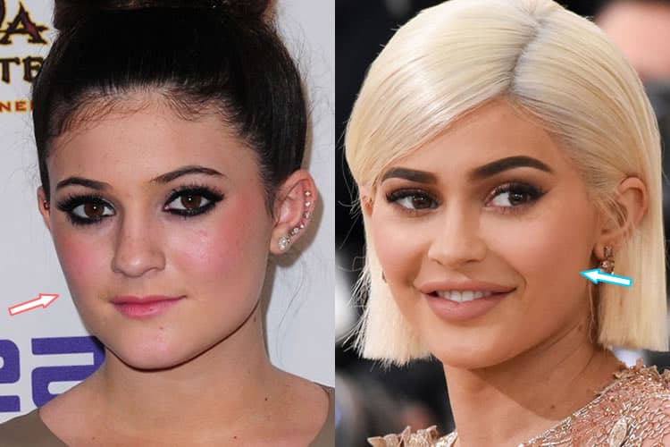 Does Kylie Jenner Have Botox & Face Lift?