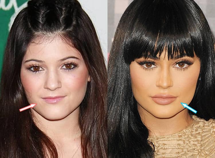 Has Kylie Jenner Had Lip Injections?