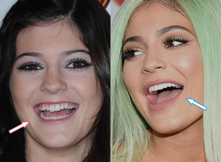 Kylie Jenner's Teeth Before and After