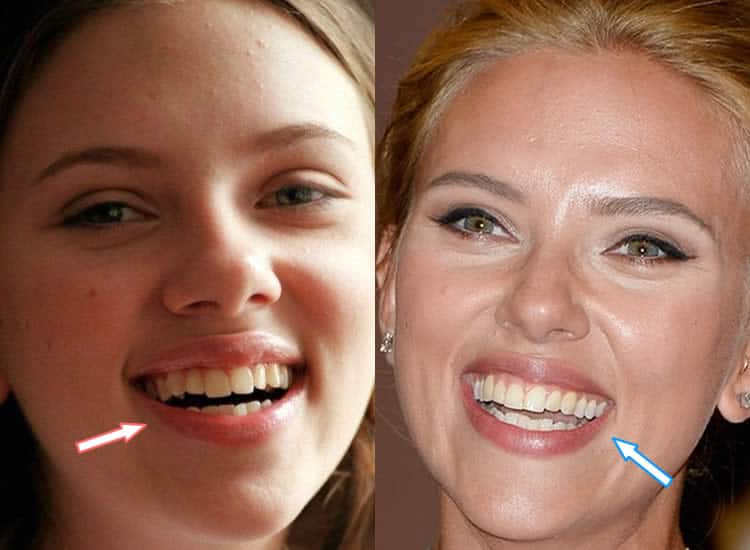 Did Scarlett Johansson Fix Her Teeth?