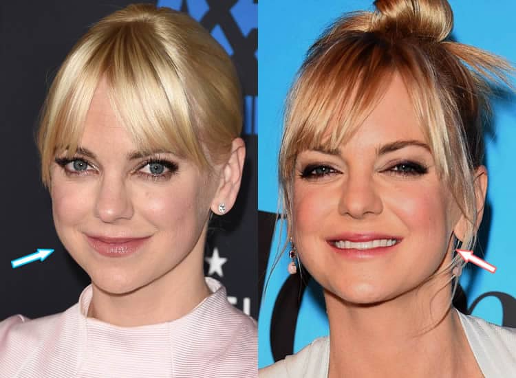 Did Anna Faris Have Botox or Facelift?