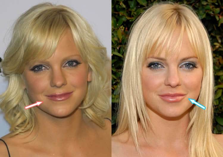 Did Anna Faris Get Lip Injections?