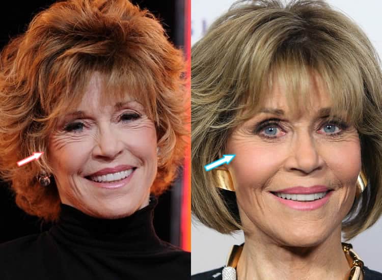 Did Jane Fonda Get an Eye Lift?