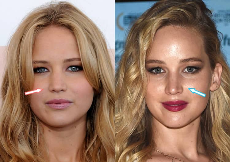 Jennifer Lawrence nose job before and after photo