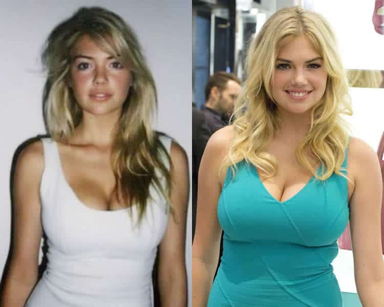 Does Kate Upton Have A Boob Job?