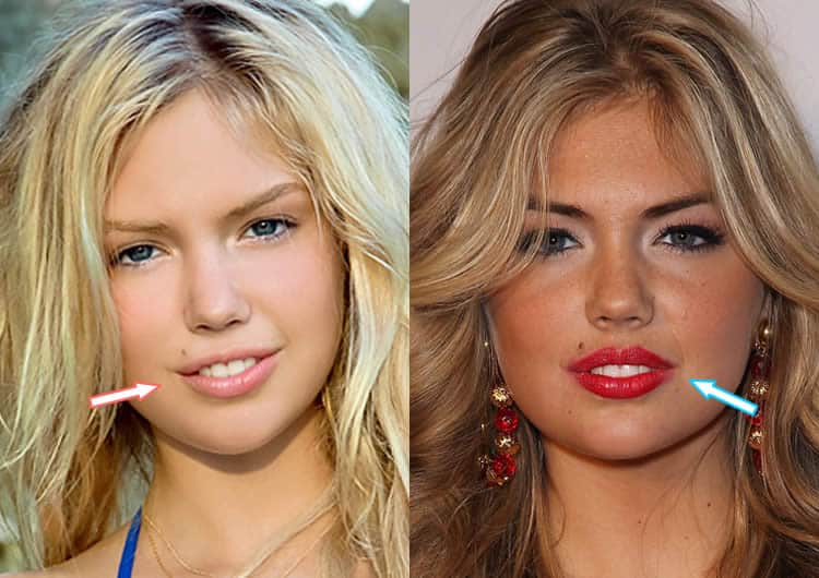 Has Kate Upton Had Lip Injections?