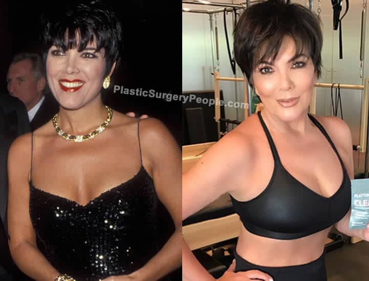Kris Jenner boob job before and after photo