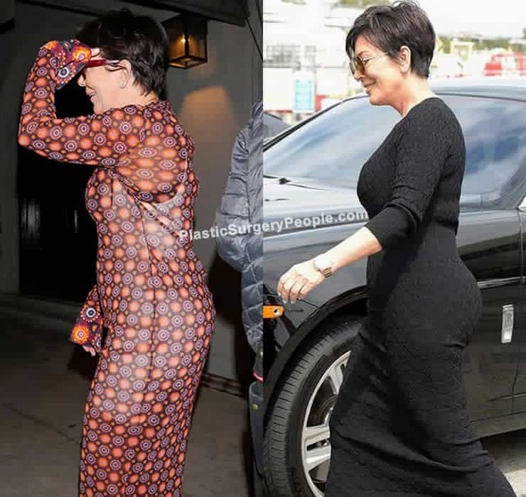 Kris Jenner butt lift before and after photo