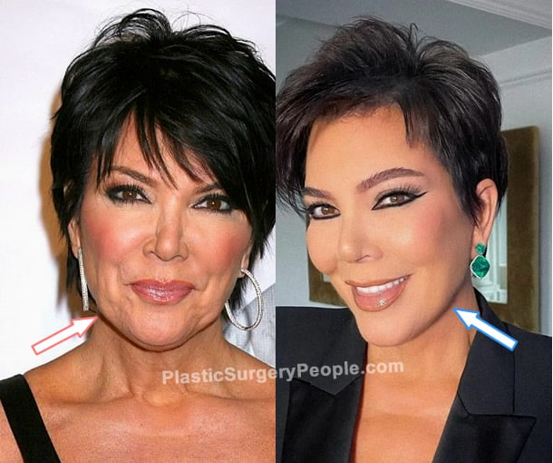 Kris Jenner facelifrt before and after photo