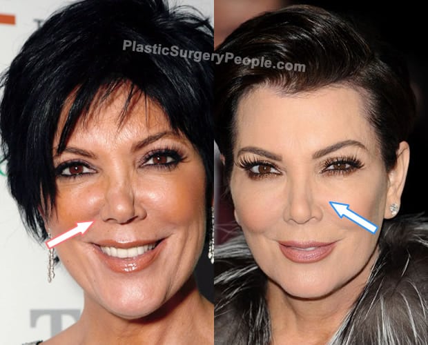 Kris Jenner nose job before and after photo