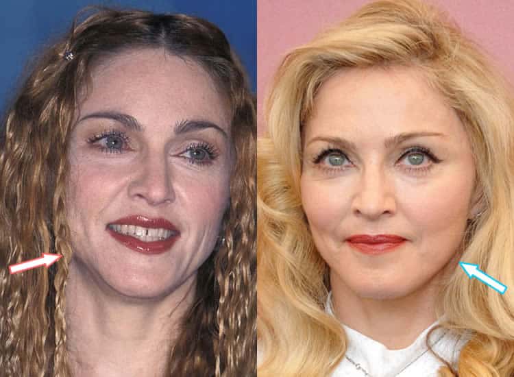 Has Madonna Had Botox?