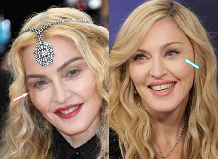 Did Madonna Get An Eye Lift?