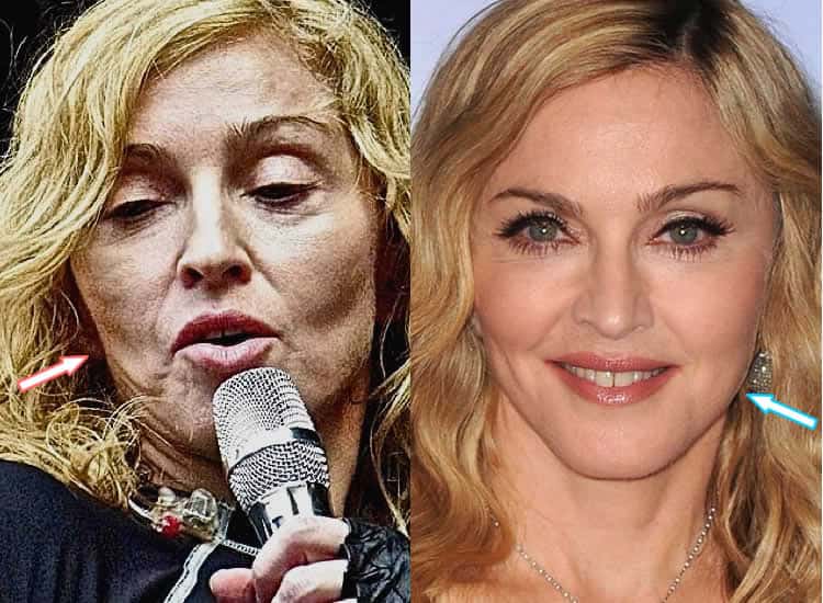 Did Madonna Have Facelift?