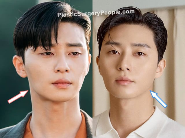 Park Seo Joon botox before and after photo