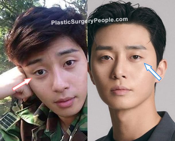 Park Seo Joon eye surgery before and after photo