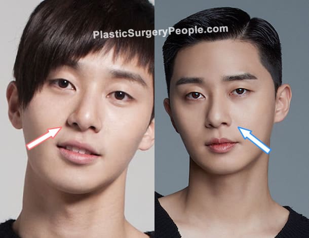 Park Seo Joon nose job before and after photo