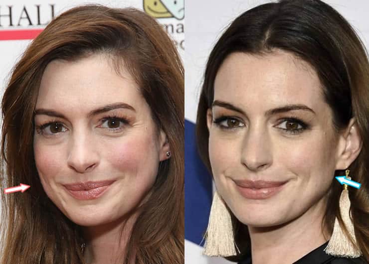 Did Anne Hathaway Get Botox or Facelift?