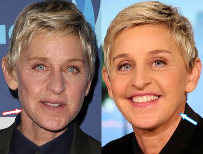 Does Ellen DeGeneres Have Botox?
