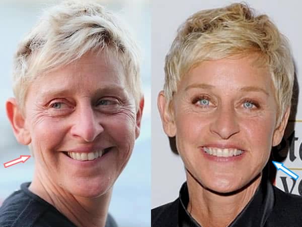 Did Ellen DeGeneres Have Facelift?