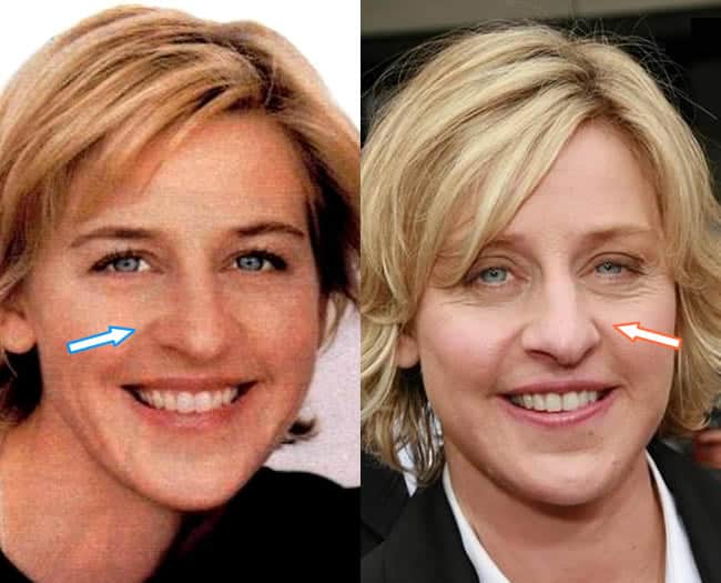 Has Ellen DeGeneres Had a Nose Job?