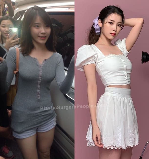 IU boob job before and after photo