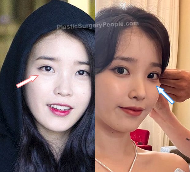 IU eyelid surgery before and after photo