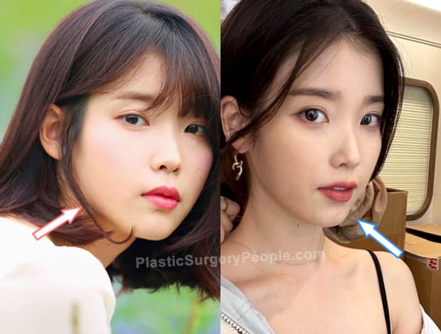 IU jawline surgery before and after photo