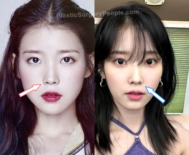 IU nose job before and after photo