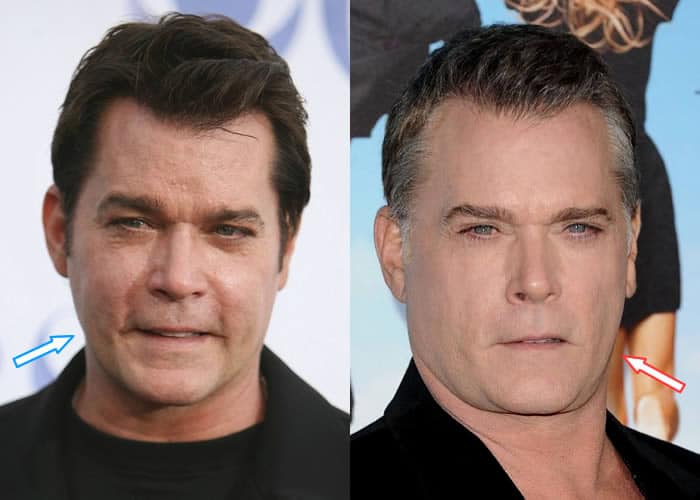 Did Ray Liotta Have Facelift?