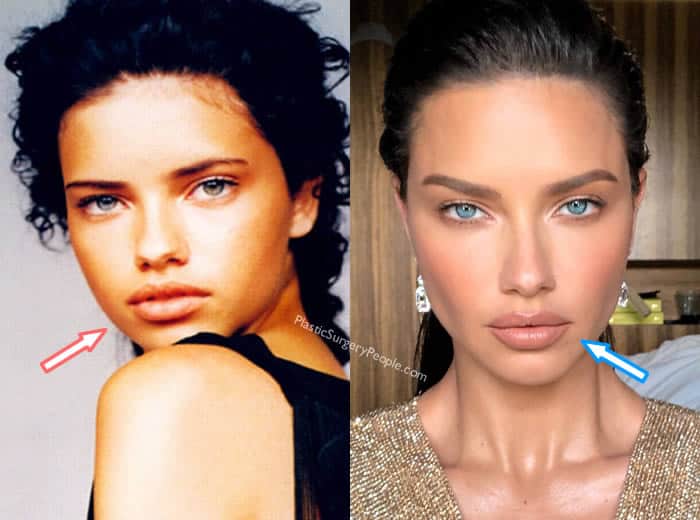 Did Adriana Lima Get Lip Injections?