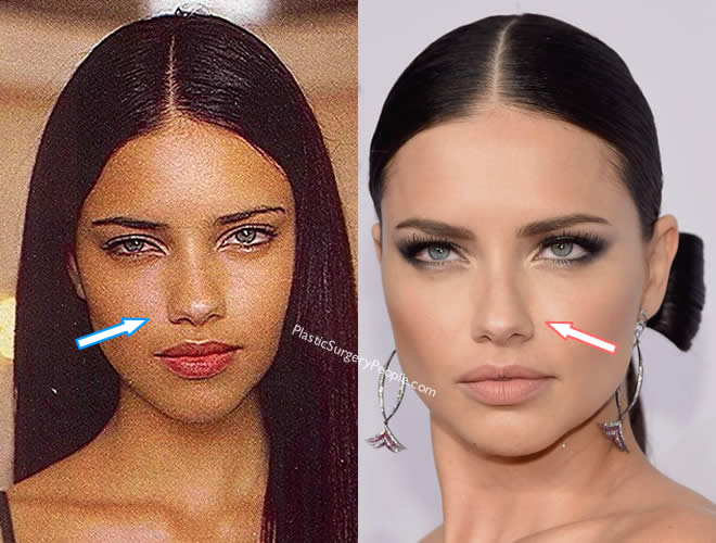 Does Adriana Lima Have Nose Job?