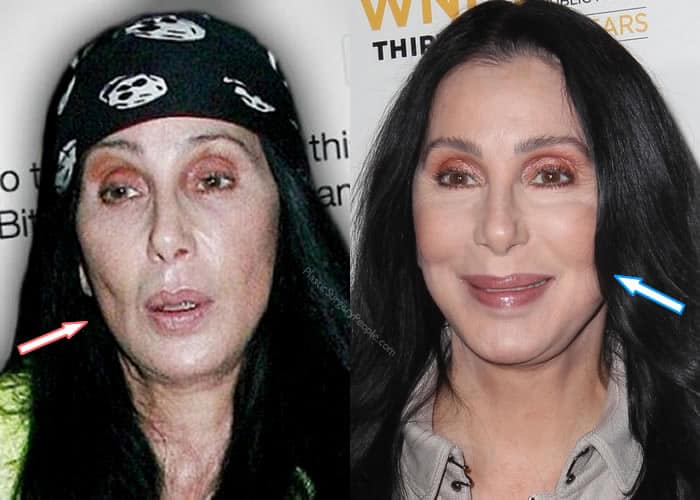 Did Cher Have Botox?