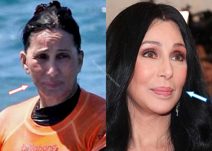 Has Cher Had a Facelift?