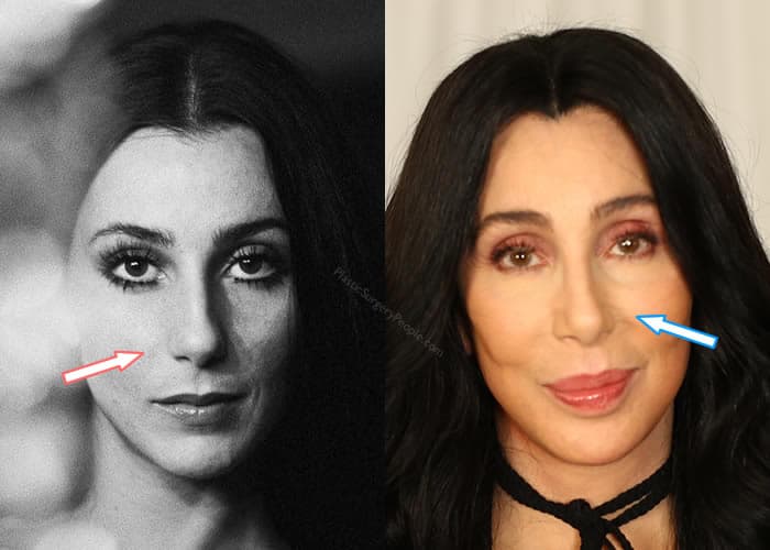 Did Cher Get a Nose Job?