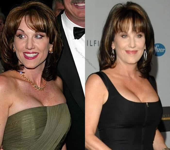 Does Robin Mcgraw Have Breast Implants?
