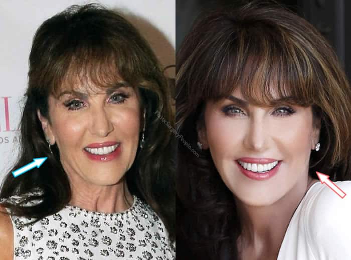 Did Robin Mcgraw Have Facelift?