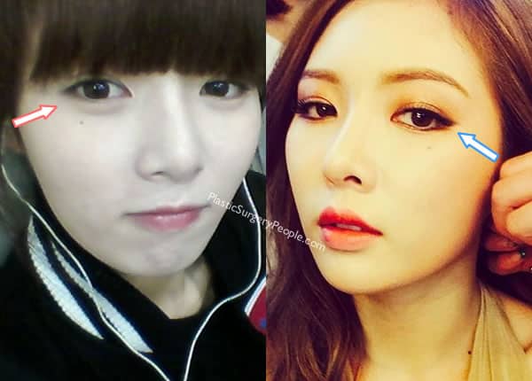Hyuna's eyes before and after