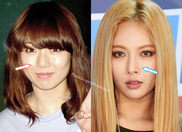 Hyuna nose job before and after