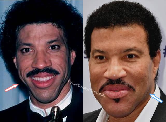 Lionel Richie Botox Before and After