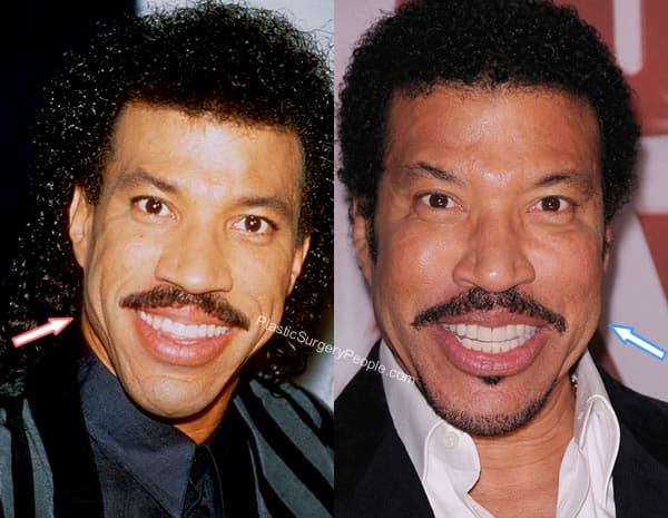 Lionel Richie Facelift Before and After
