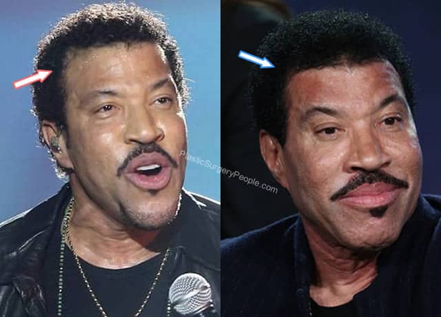 Lionel Richie Hair Transplant Before and After
