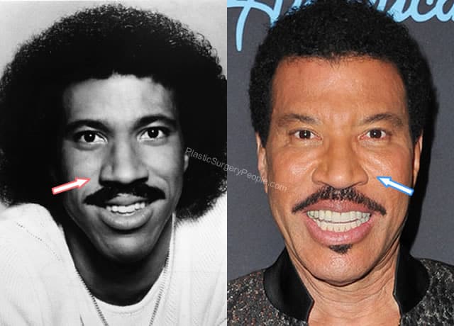 Lionel Richie Nose Job Before and After