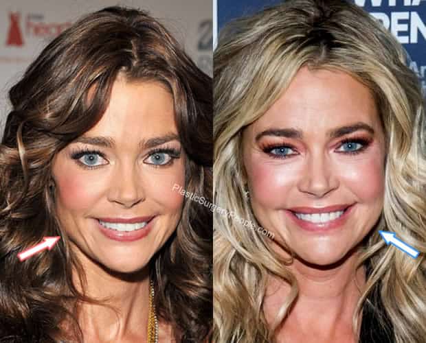 Denise Richards botox before and after